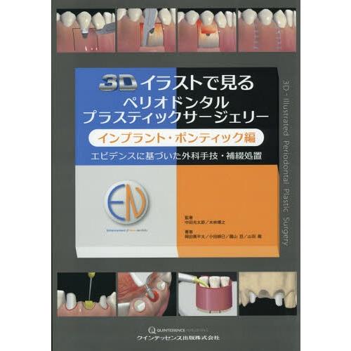 3Dイラストで見るペリオドンタルプラスティックサージェリー インプラント・ポンティック編