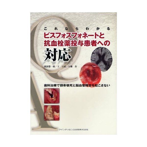 これならわかるビスフォスフォネートと抗血栓薬投与患者への対応 歯科治療で顎骨壊死と脳血管障害を起こさない