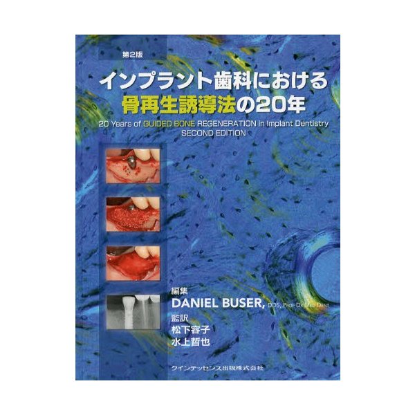 インプラント歯科における骨再生誘導法の20年