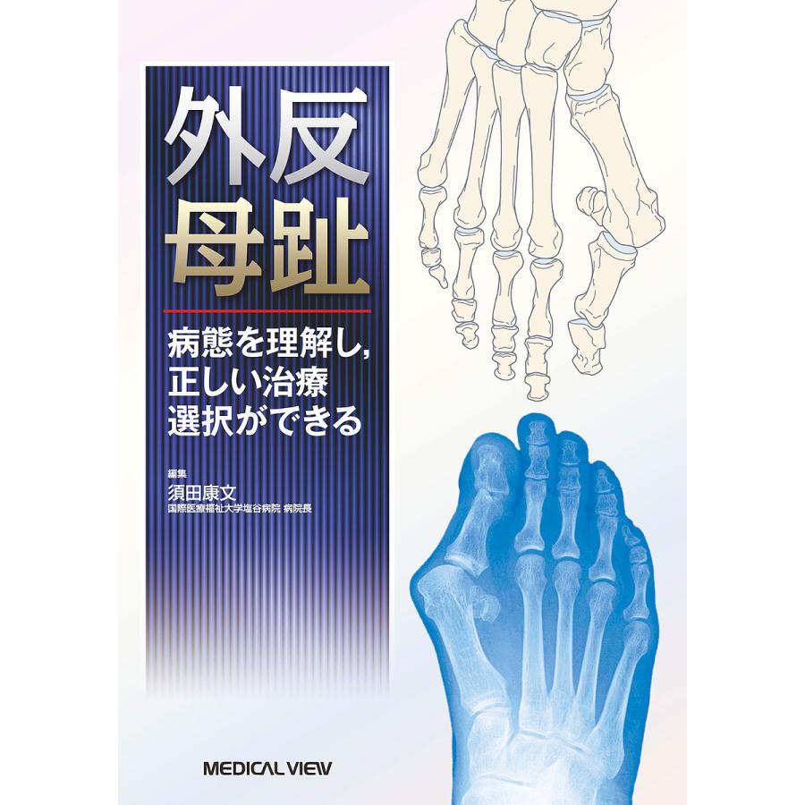 外反母趾 病態を理解し,正しい治療選択ができる