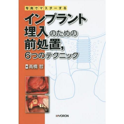 写真でマスターするインプラント埋入のための前処置 6つのテクニック 高橋哲 著