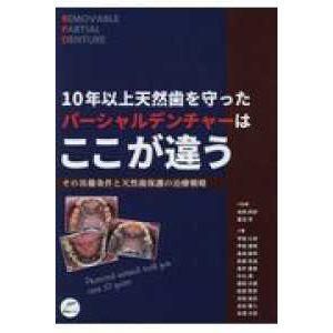 １０年以上天然歯を守ったパーシャルデンチャーはここが違う―その具備条件と天然歯保護の治療戦略