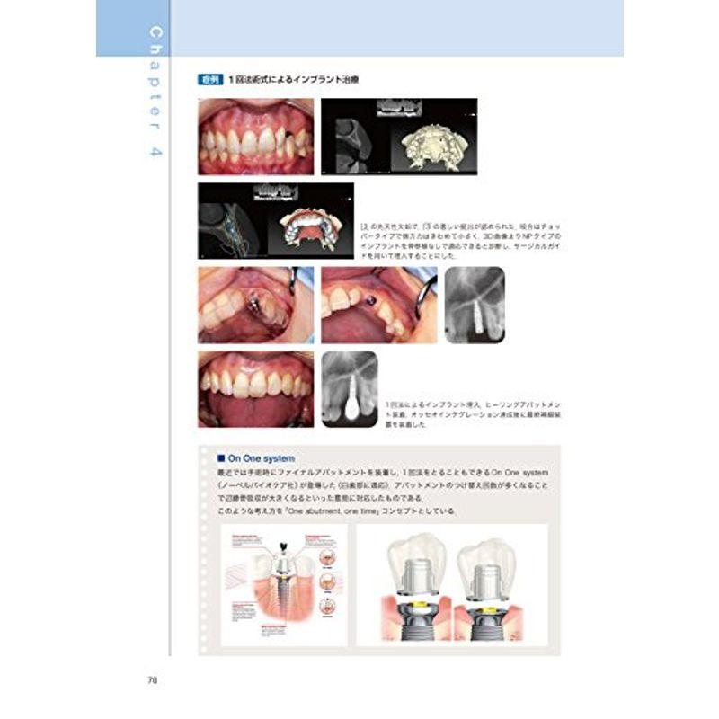 インプラント治療の理論と実践 低侵襲で長期安定のために