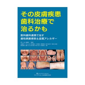 その皮膚疾患歯科治療で治るかも 医科歯科連携で治す歯性病巣感染 金属アレルギー