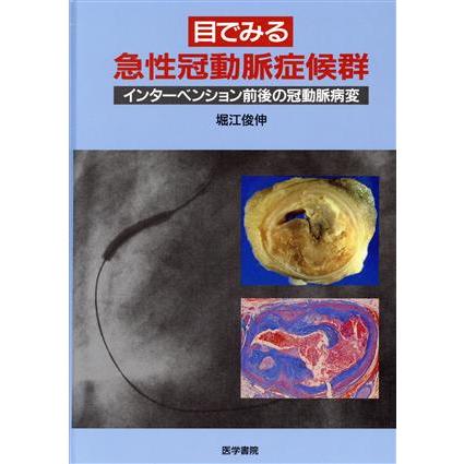 目でみる急性冠動脈症候群 インターベンション前後の冠動脈病変／堀江俊伸(著者)