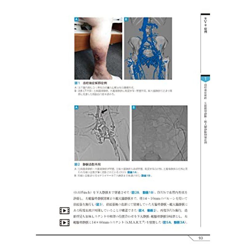 慢性深部静脈不全の評価と治療 -動画を含む電子版付-