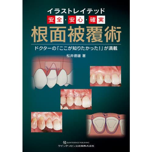 イラストレイテッド安全・安心・確実 根面被覆術 ドクターの ここが知りたかった が満載