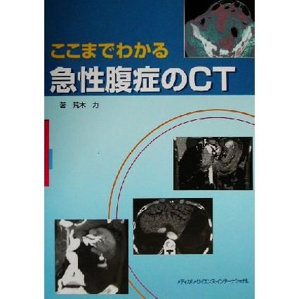 ここまでわかる急性腹症のＣＴ／荒木力(著者)