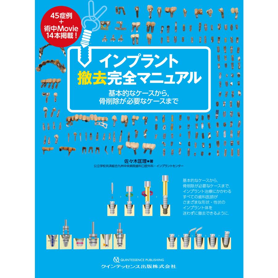 インプラント撤去完全マニュアル 基本的なケースから,骨削除が必要なケースまで