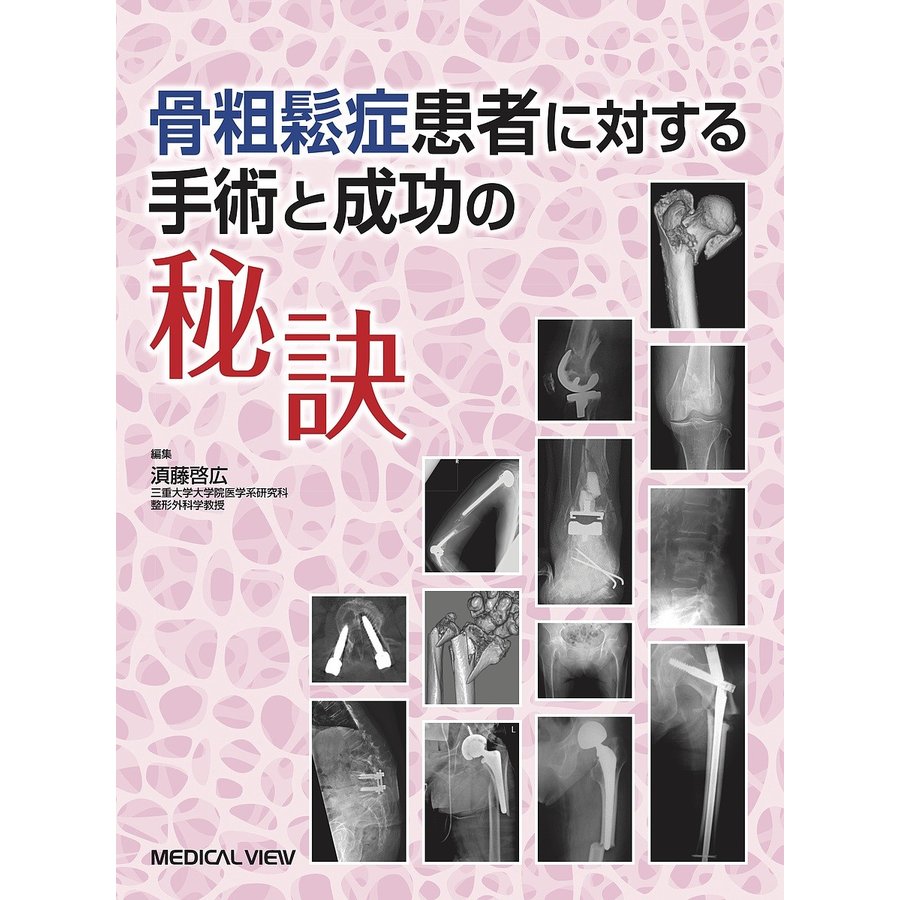 骨粗鬆症患者に対する手術と成功の秘訣