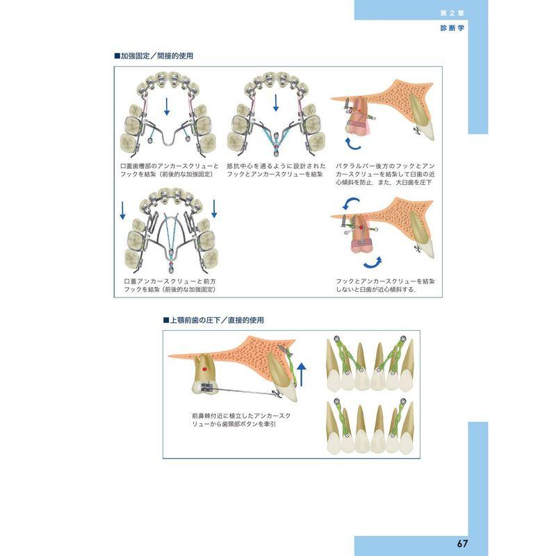 リンガルブランケット矯正の臨床