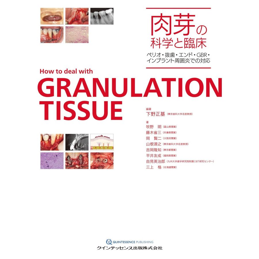 肉芽の科学と臨床-ペリオ・抜歯・エンド・ＧＢＲ・インプラント周囲炎での対応