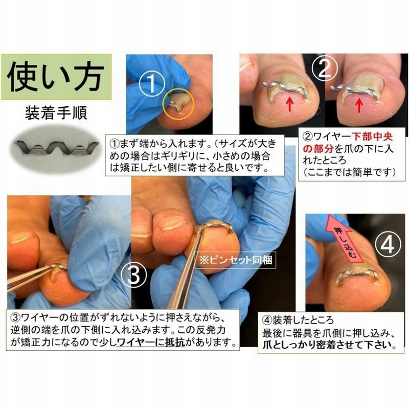 新品未使用品、16mm、巻き爪 矯正、ネイル・エイド、ワイヤー クリップ 巻き爪治療 巻き爪矯正 自分で ネイルエイド 16mm ワイヤー