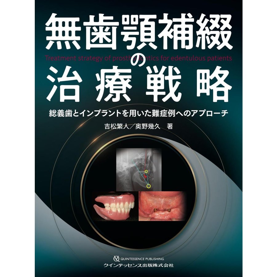 無歯顎補綴の治療戦略 総義歯とインプラントを用いた難症例へのアプローチ