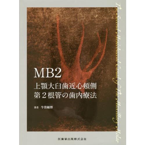 MB2 上顎大臼歯近心頬側第2根管の歯内療法