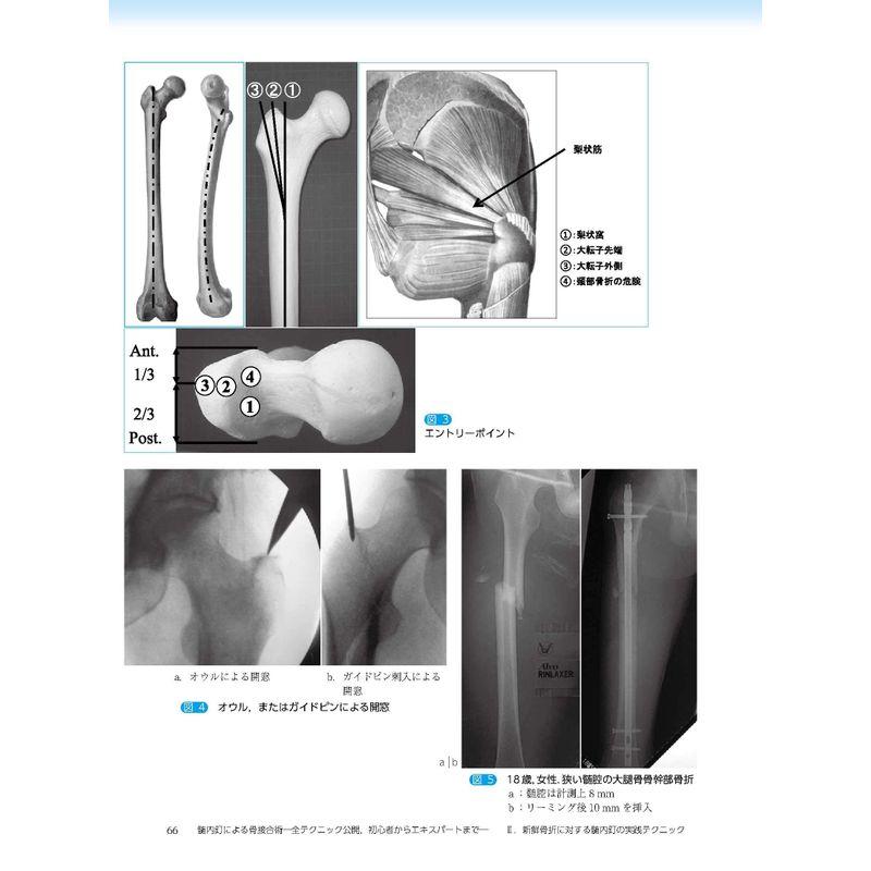 髄内釘による骨接合術 ー全テクニック公開,初心者からエキスパートまでー