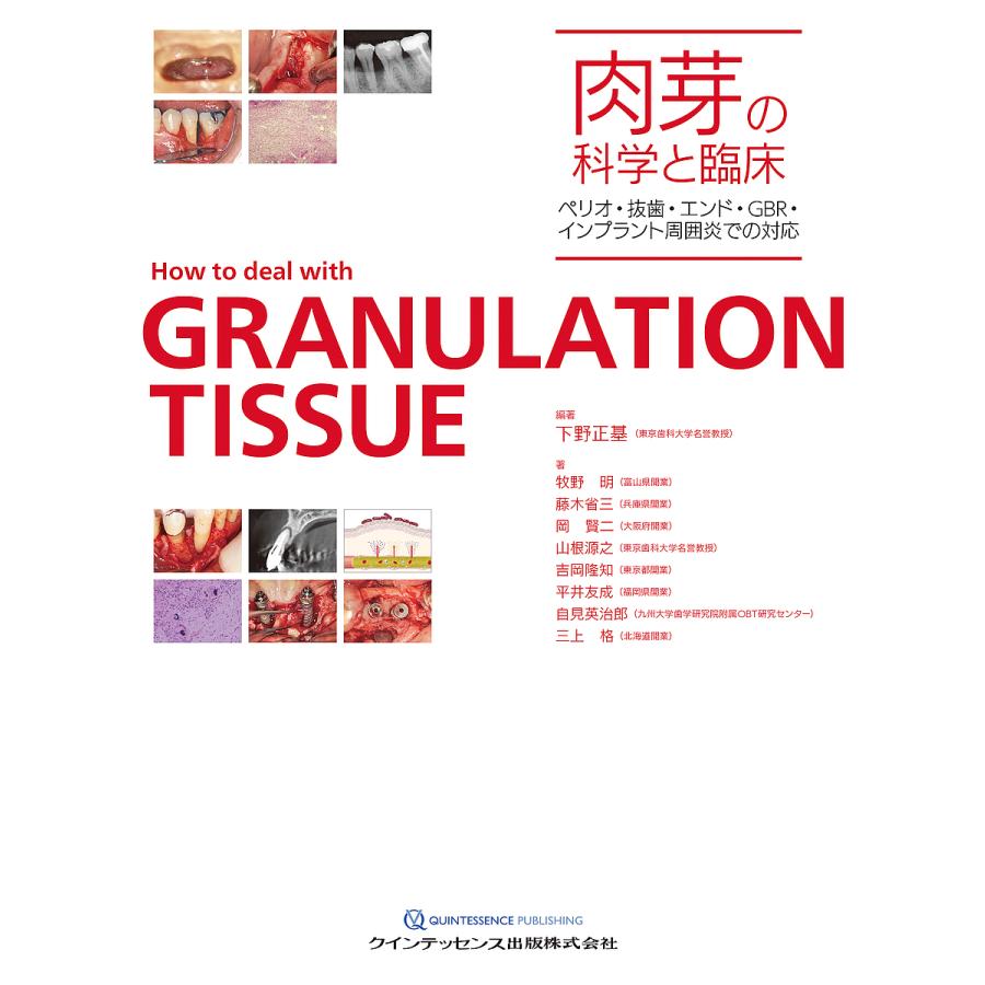 肉芽の科学と臨床 ペリオ・抜歯・エンド・GBR・インプラント周囲炎での対応