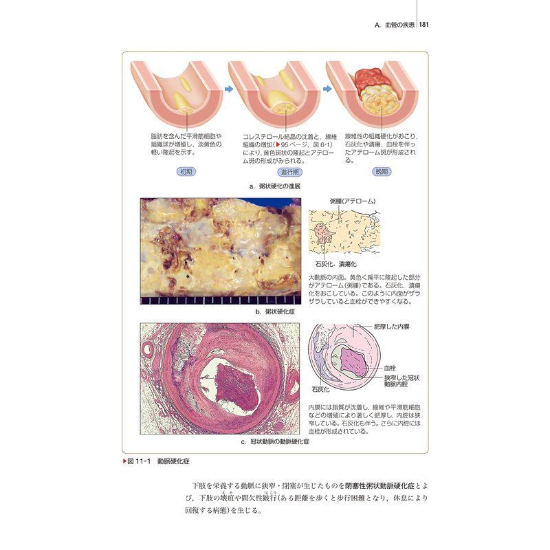 疾病のなりたちと回復の促進1 病理学 第6版