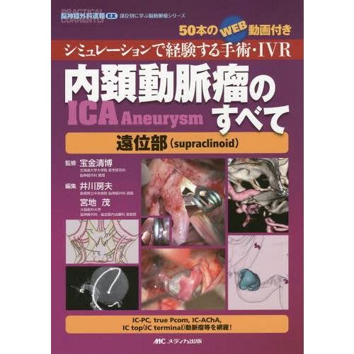 内頚動脈瘤 のすべて-遠位部 シミュレーショ