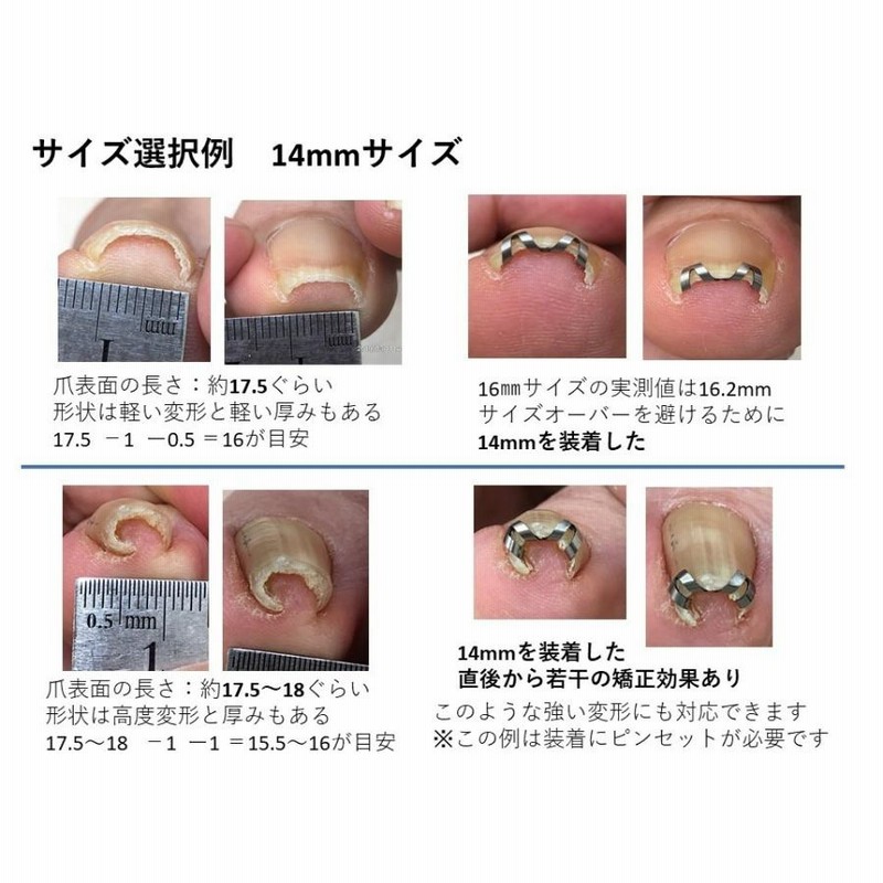 巻き爪 治し方 まきづめ 治療 ネイルエイド １４ｍｍ 自分で矯正