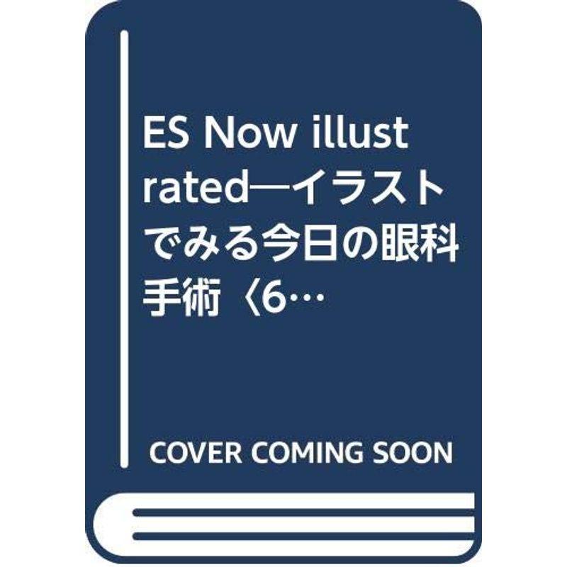 ES Now illustrated?イラストでみる今日の眼科手術〈6〉水疱性角膜症