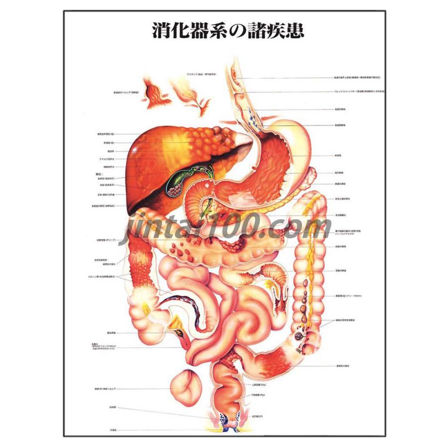 消化器系の諸疾患」医学ポスター ポスターB2サイズ 人体解剖学図 