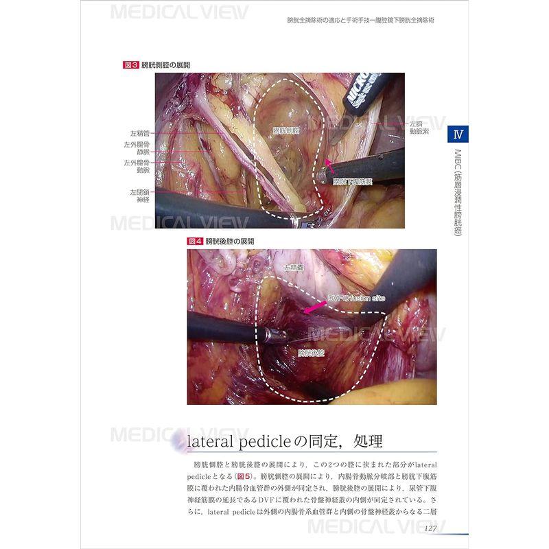 膀胱癌診療最前線