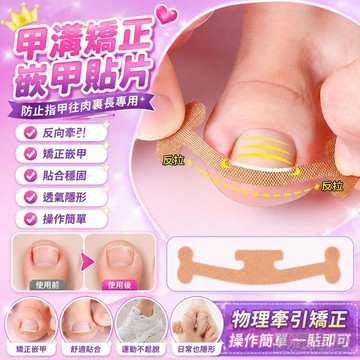🚀隔日現發🚀甲溝矯正器 嵌甲貼片 炎指甲矯正器 防止指甲往肉裏長專用 指甲長肉裏腳拉拉貼 嵌甲墊捲
