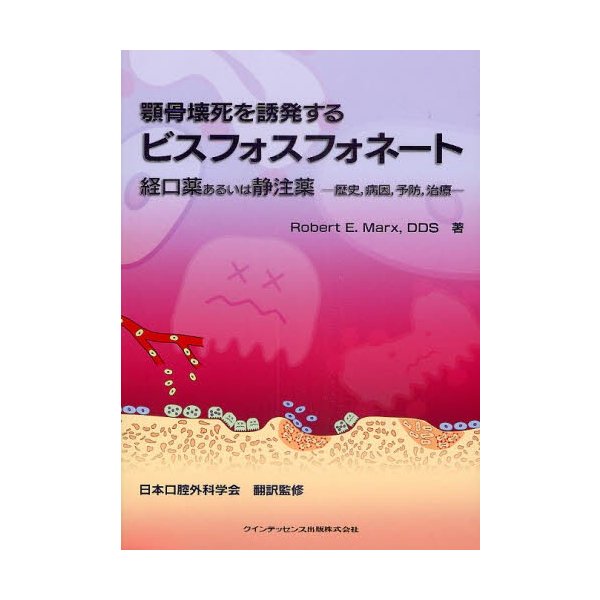 顎骨壊死を誘発するビスフォスフォネート 経口薬あるいは静注薬 歴史,病因,予防,治療