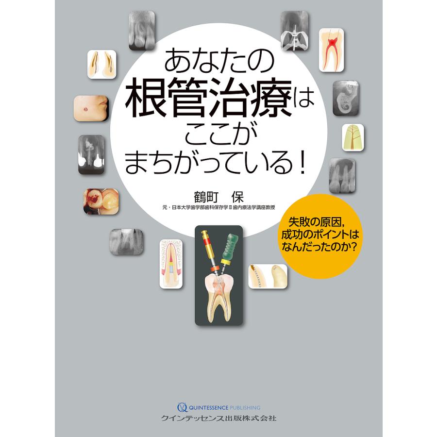 あなたの根管治療はここがまちがっている! 失敗の原因,成功のポイントはなんだったのか? 鶴町保