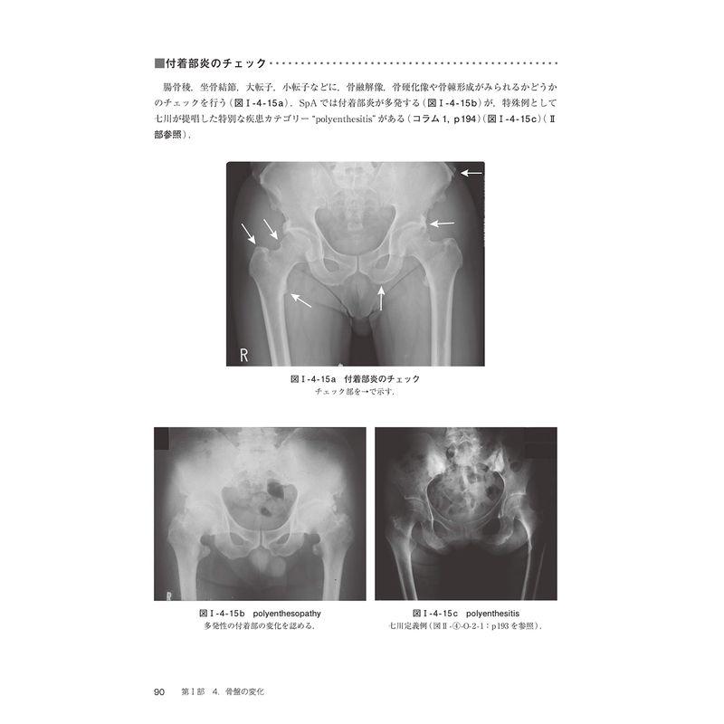 村田流 リウマチ性疾患の読影法 手,頚椎,腰椎,骨盤,足のXPからー