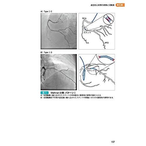 そうだったのか!  絶対読めるCAG?シェーマでわかる冠動脈造影の読み方