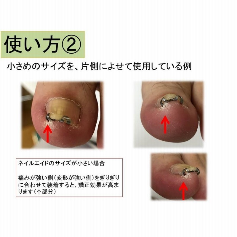 新品未使用品、16mm、巻き爪 矯正、ネイル・エイド、ワイヤー クリップ Amazon | ネイルエイド 16㎜ 巻き爪 矯正 自分で 巻きづめ