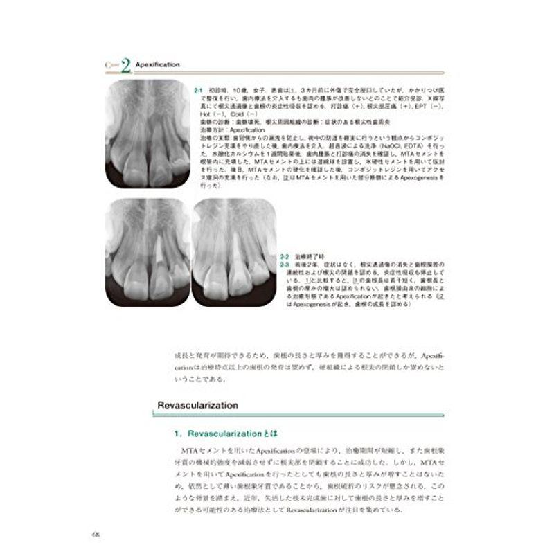 MTAを用いたエンドの臨床 予知性の高いバイオセラミックマテリアルの応用法