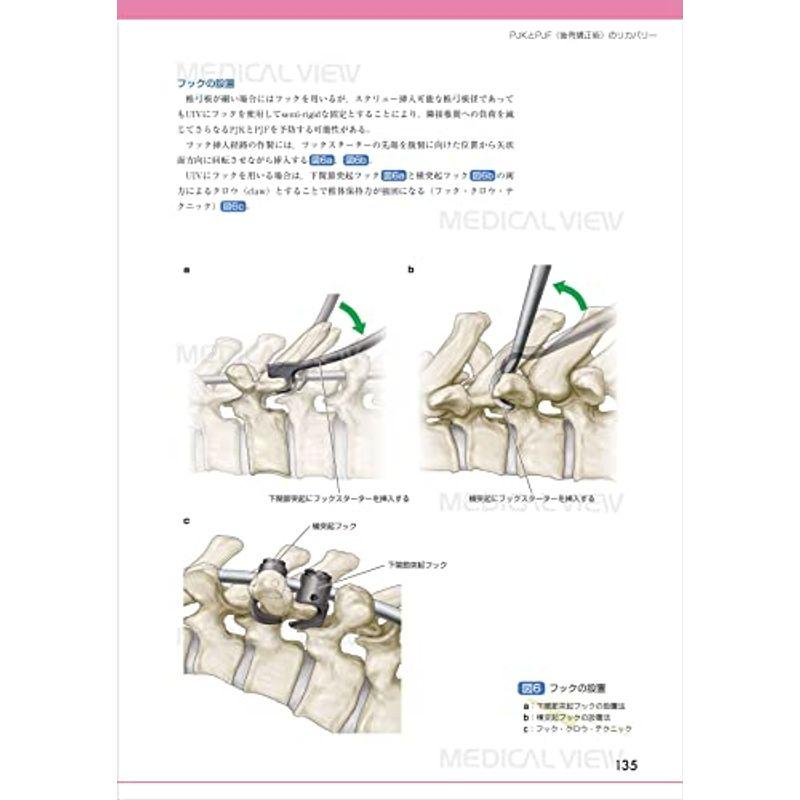 脊椎手術と合併症 回避の技とトラブルシューティング 激安通販専門店