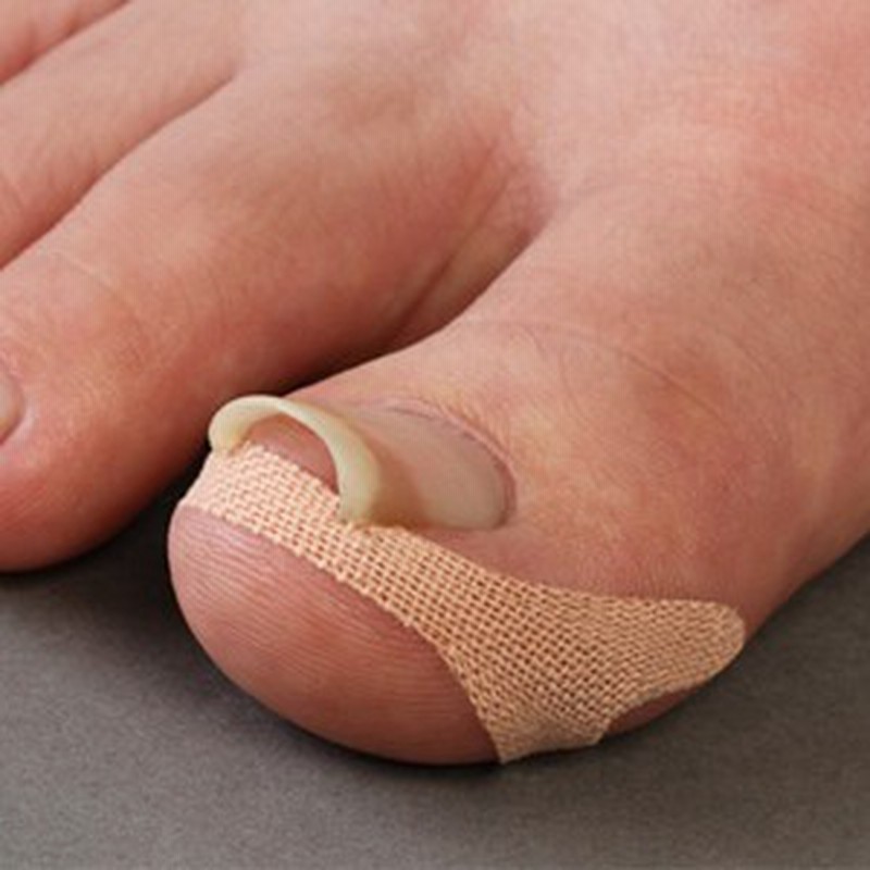 巻き爪テープ クイこまーぬ 60枚入 巻き爪サポーター 巻き爪ワイヤー 巻爪矯正 巻き爪ケアテープ メール便 送料無料 通販 Lineポイント最大1 0 Get Lineショッピング