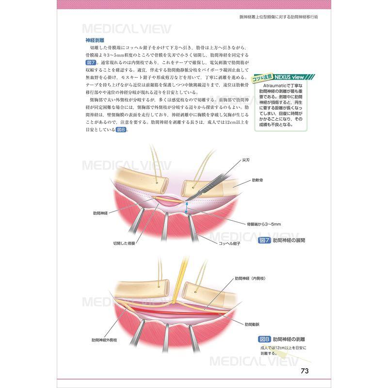 末梢神経障害・損傷の修復と再建術 17)