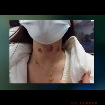 免運下殺💯【約會神器】草莓吻痕去除神器去除脖子頸部印專用約會必備膏