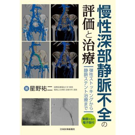 慢性深部静脈不全の評価と治療