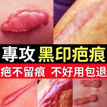 疤痕膏 各種疤痕留印 痘疤 痘印 妊娠紋 燒燙傷疤 手術疤痕 疤痕霜 疤紋霜 早晚各一次 溫和不刺激 男女通用