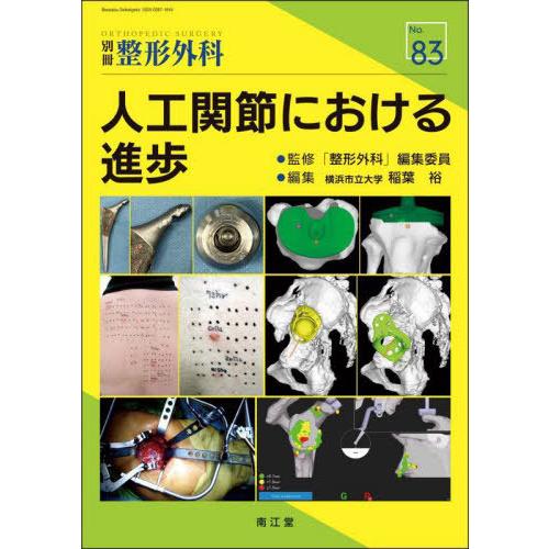 人工関節における進歩