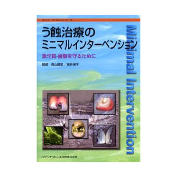 う蝕治療のミニマルインターベンション 象牙質-歯髄を守るために