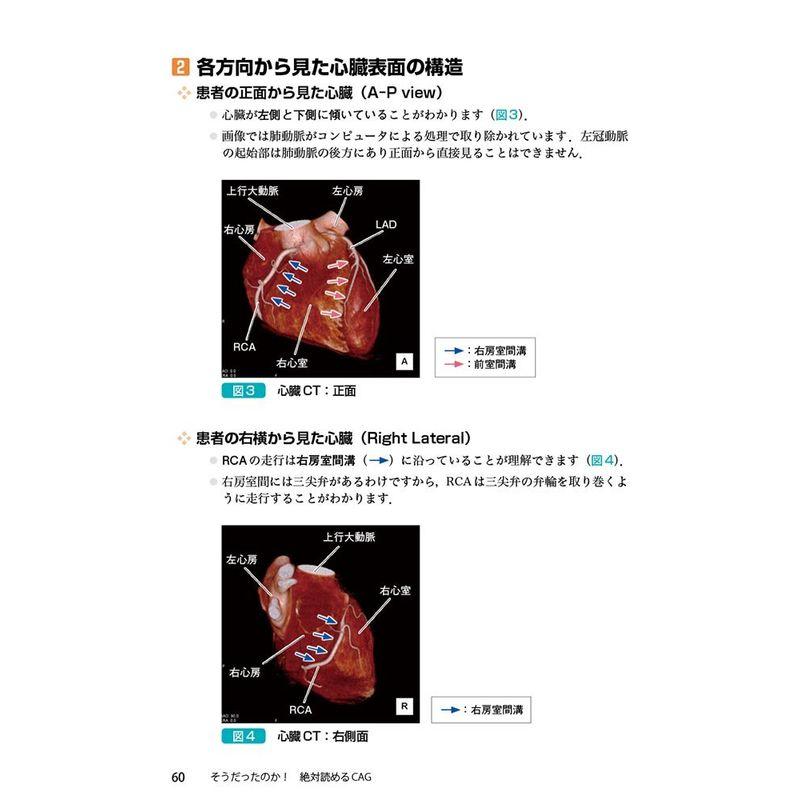 そうだったのか 絶対読めるCAG~シェーマでわかる冠動脈造影の読み方