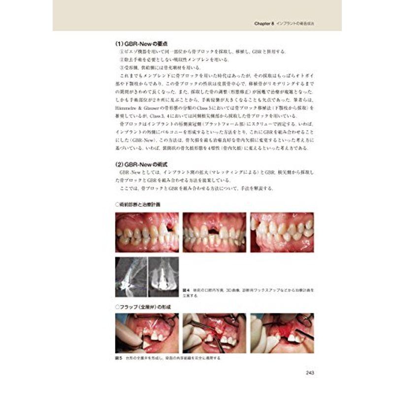 インプラント治療の理論と実践 低侵襲で長期安定のために