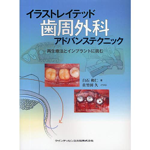 イラストレイテッド歯周外科アドバンステクニック 再生療法とインプラントに挑む 白石和仁 佐竹田久