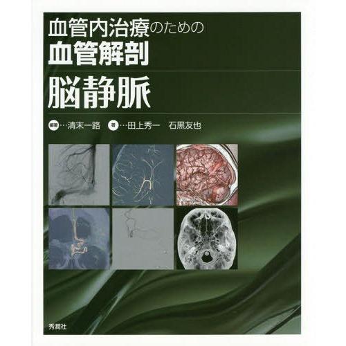 血管内治療のための血管解剖脳静脈