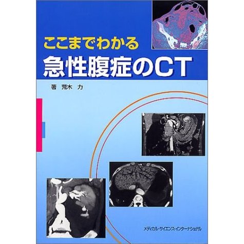 ここまでわかる急性腹症のCT