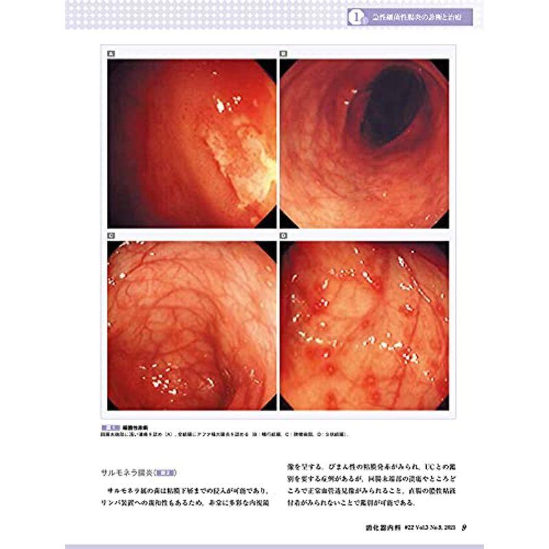 消化器内科 第22号(Vol.3 No.9,2021)特集:広義の炎症性腸疾患(IBD)?重要疾患の最新知見と罹患部位による鑑別診断?