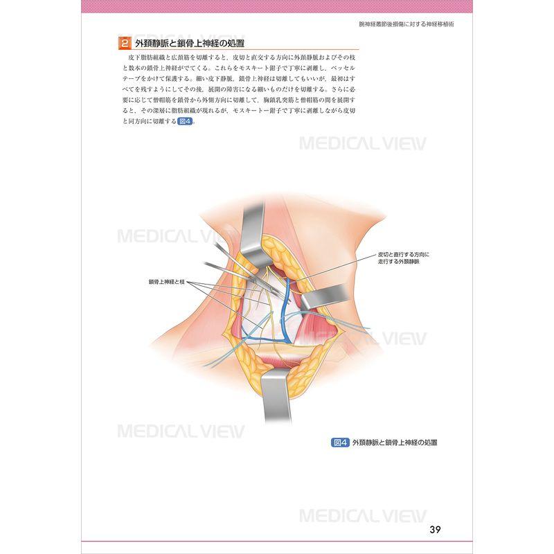 末梢神経障害・損傷の修復と再建術 17)