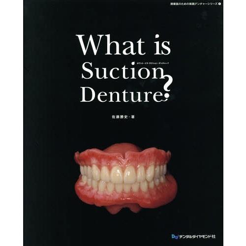 What is Suction Denture